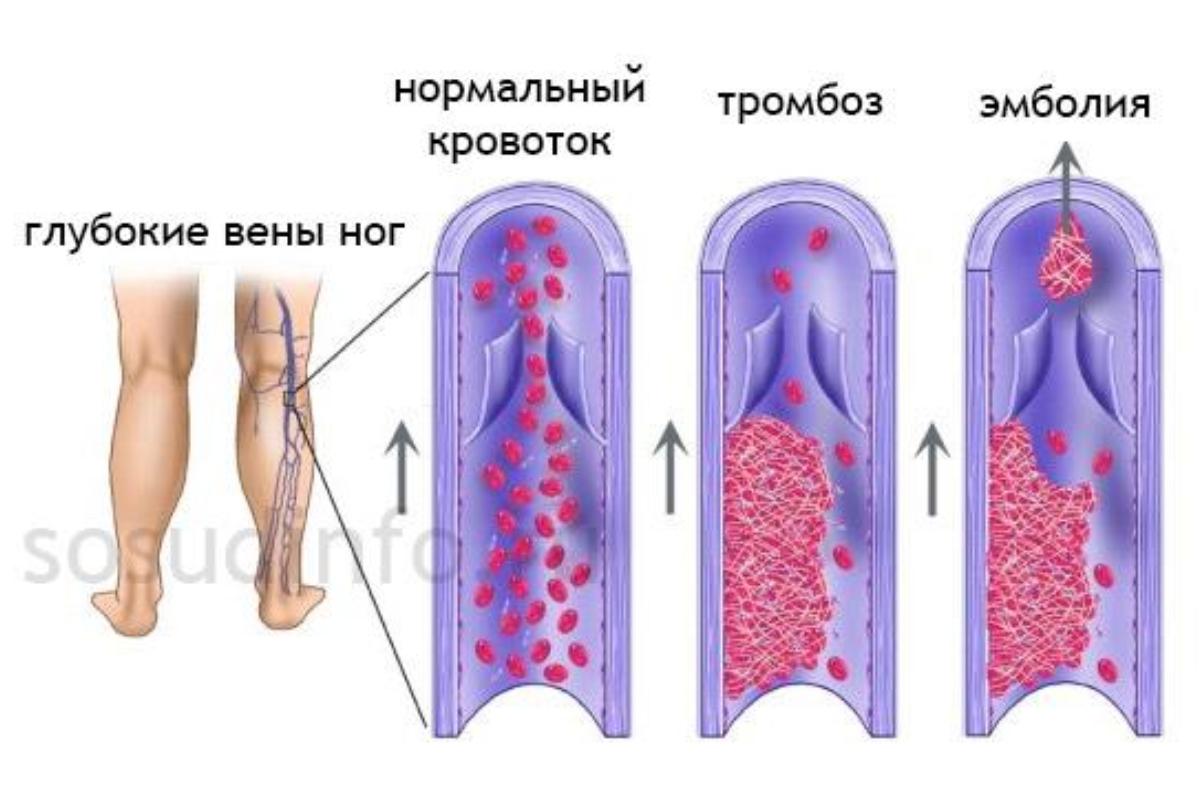 Зеленоград, новости: Прием флеболога в клинике «АрхиМЕД»